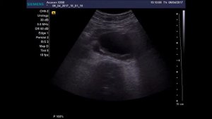 Аневризма аорты