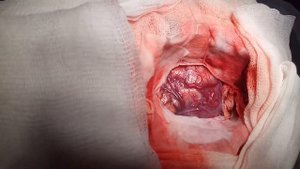 Внешний вид артерио-венозной мальформации головного мозга