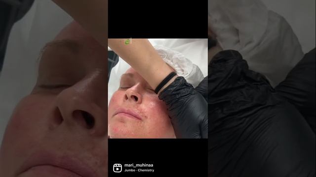 Пилинг TC DuoPeel Биоревитализант #пилинг #биоревитализация #возраст #воспаление смотреть онлайн