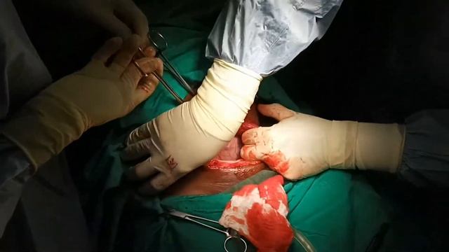 анестезия и кесарево