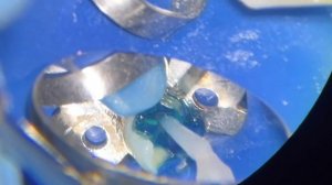 Распломбировка корневого канала 34з извлечение инструмента, обтурация, установка стекловол-го штифт