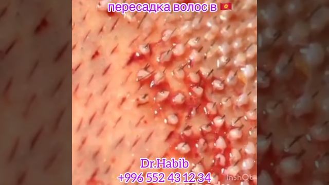 пересадка волос в бишкеке смотреть онлайн