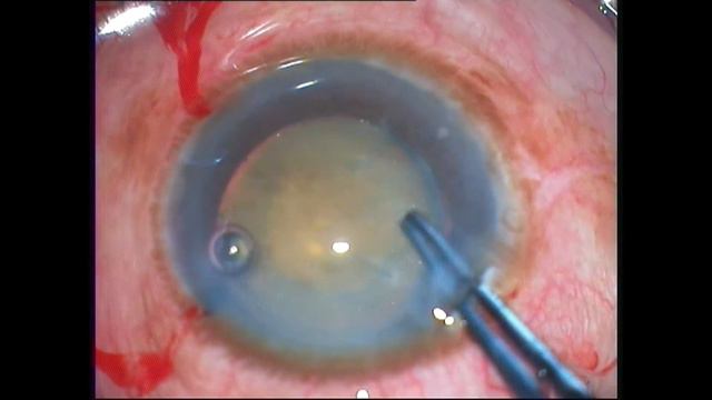 Phacoemulsification in phacolytic glaucoma with cholesterolosis смотреть онлайн
