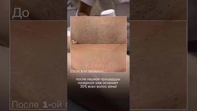 Потратили 80 тысяч, но лазерная эпиляция не сработала?? смотреть онлайн