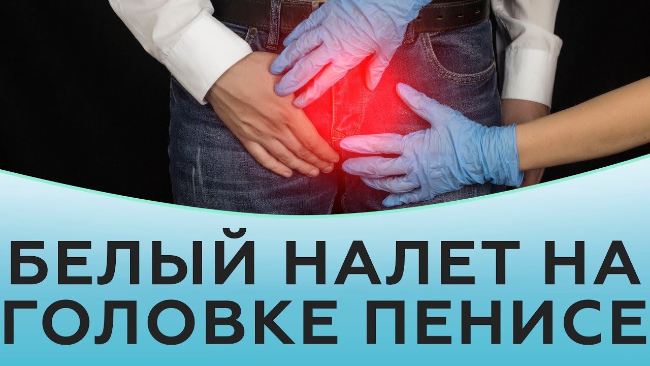 Белый налет на головке полового члена у мужчин.