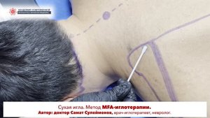 Сухая игла. LEVATOR SCAPULAE. Мышца, поднимающая лопатку. Мастер-класс врача-иглотерапевта.