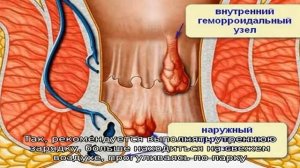 Болезненная дефекация при геморрое