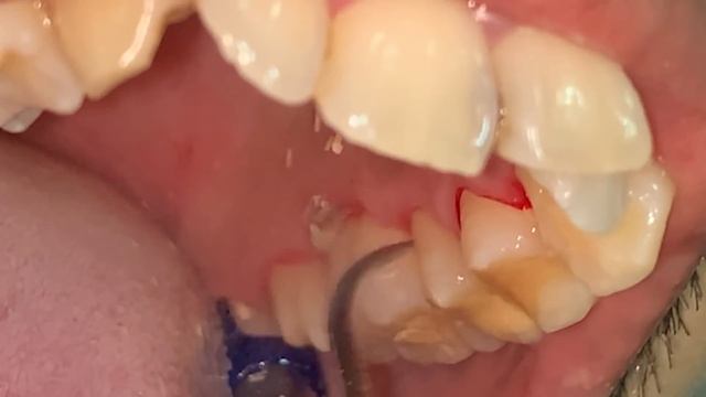 Half Jaw Quarter Hour Scaling | Dentist | Dokter Gigi Tri Putra смотреть онлайн