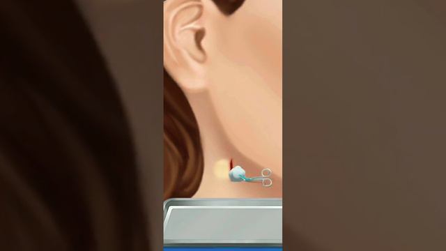 How to Remove Cyst from throat. Cervical pain in Neck, Neck pain relief