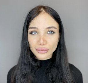 Риносептопластика: результат спустя 2 месяца.