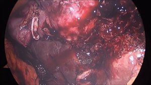 Опухоль желчного пузыря + резекция печени