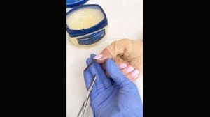 Достают непонятного червя из пальца / They take out an incomprehensible worm from the finger