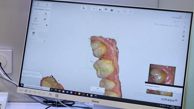 Имплантация и протезирование All-on-4 смотреть онлайн