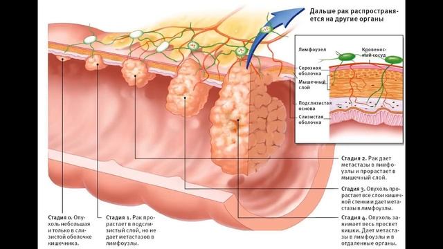 Рак прямой кишки первые симптомы смотреть онлайн