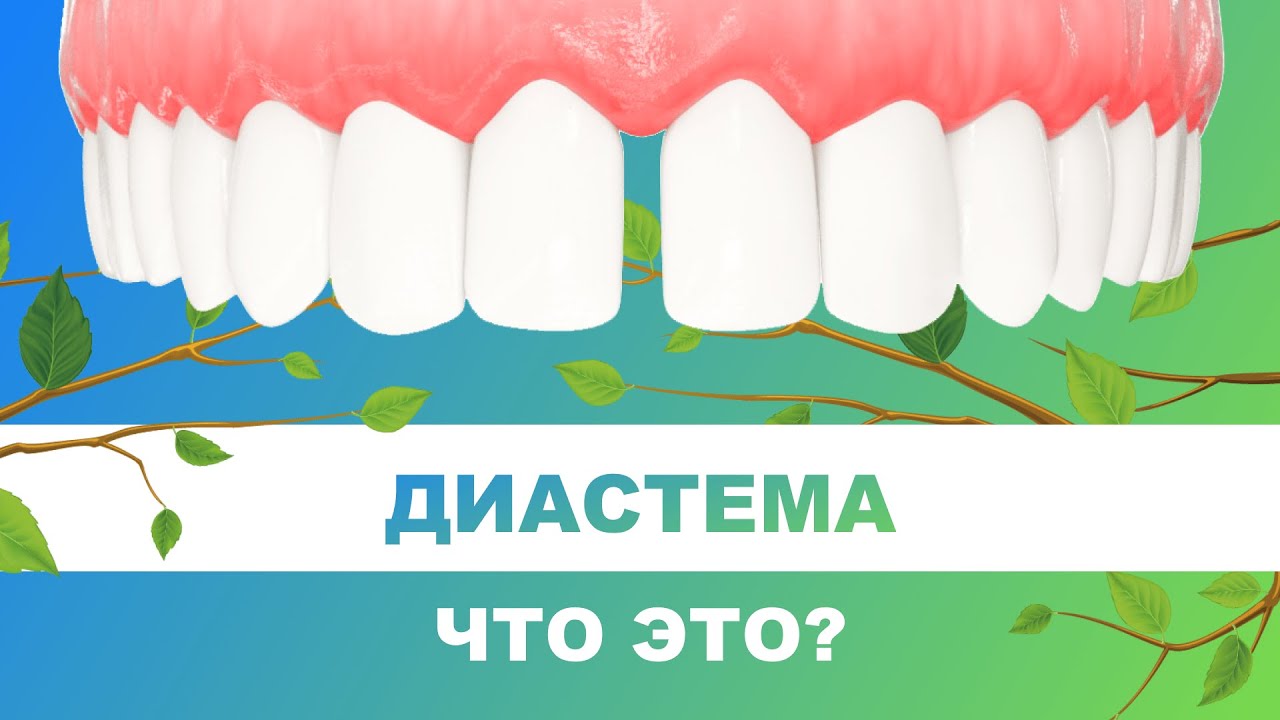 ? Диастема - что это такое. Нужно ли лечить диастему?