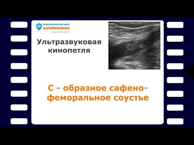 С - образное сафено-феморальное соустье