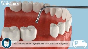 Зубные коронки: зубная коронка с опорой на вкладки