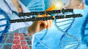 Псориаз на руках: фото начальной стадии, чем лечить