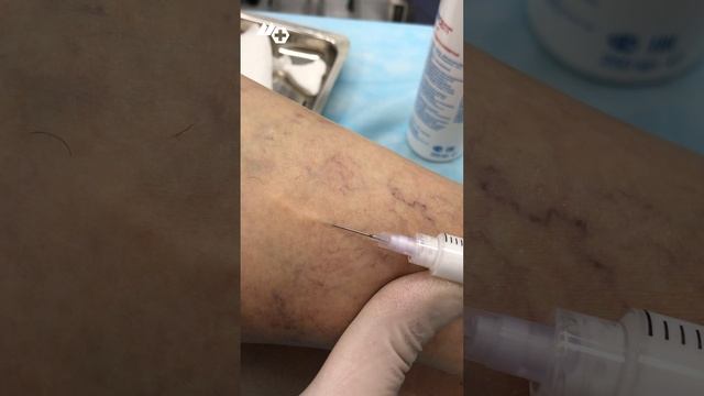Удаление сосудистых звездочек склеротерапия.mov