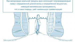 Иссечение анальной трещины Лазером