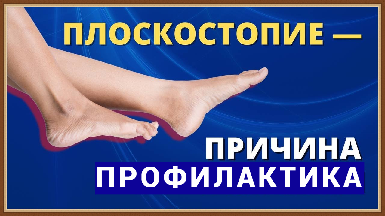 ПЛОСКОСТОПИЕ - ПРИЧИНА ПРОФИЛАКТИКА