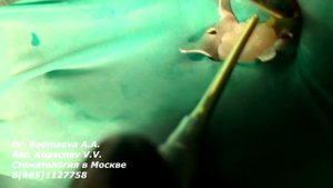 Художественная реставрация зуба