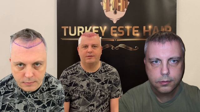 Идеальный результат пересадки волос через 5 месяцев #пересадкаволос
