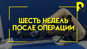 Шесть недель после операции. Пластика передней крестообразной связки. (ПКС)