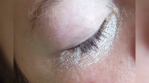 Процедура камуфляжа кругов под глазами