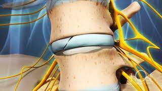 Как образуется грыжа диска. смотреть онлайн