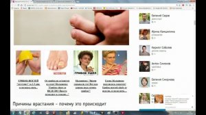 Лечение Вросшего Ногтя Без Операции За 3 Дня. Убираем дикое мясо без боли.