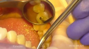 Фиксация коронки на имплантате