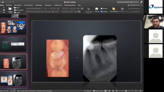 Вебинар на русском языке -Артур Мухарбиевич - Тема: Виды инструментальной обработки корневых канало смотреть онлайн
