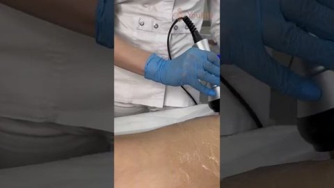 Аппаратная липосакция