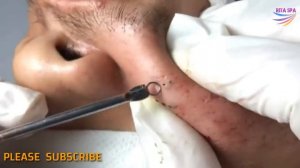 BLACKHEADS REMOVAL on face | how to get rid of blackheads & whiteheads   series acne treatment #020