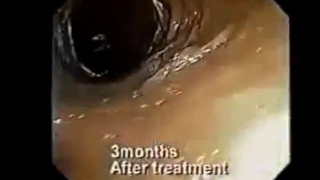 Очищение кишечника щелочной ионизированной водой.