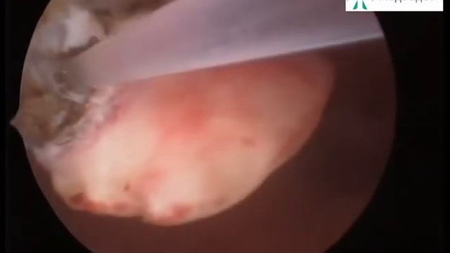 Офисная гистероскопия полип в постменопаузе
