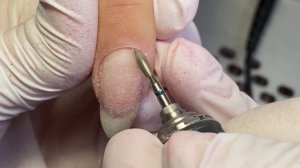 Трещина На Ногте в мясо Надёжный Ремонт Акригелем #какремонтироватьногти #ремонтногтейакригелем