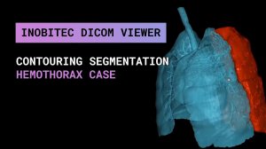 Сегментация контуров в Inobitec DICOM Viewer Pro на примере гемоторакса