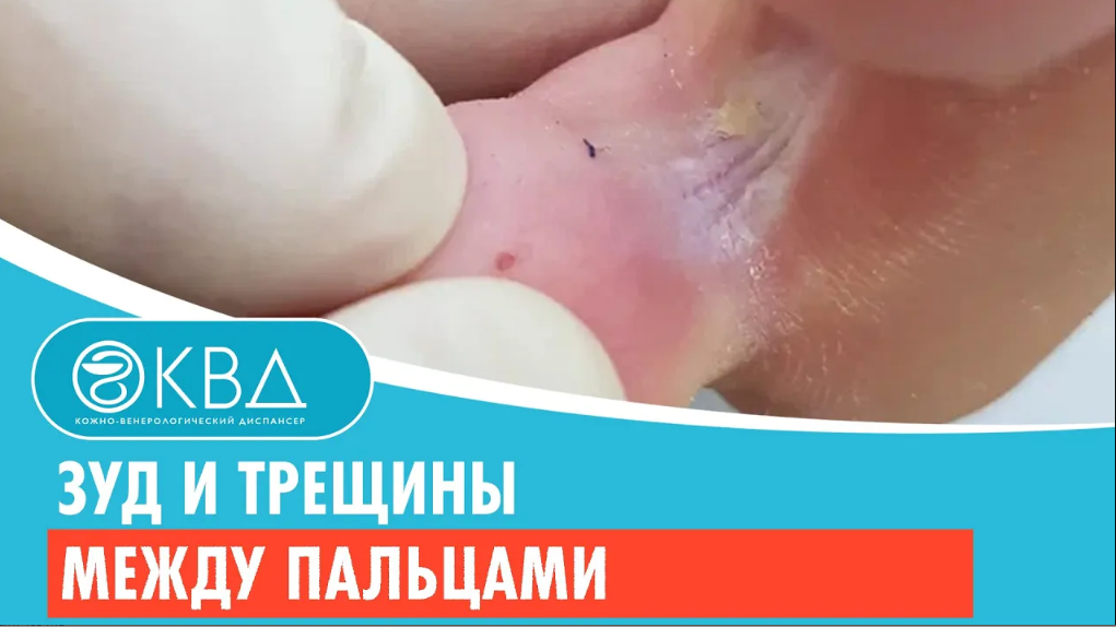 ? Зуд и трещины между пальцами. Клинический случай №374