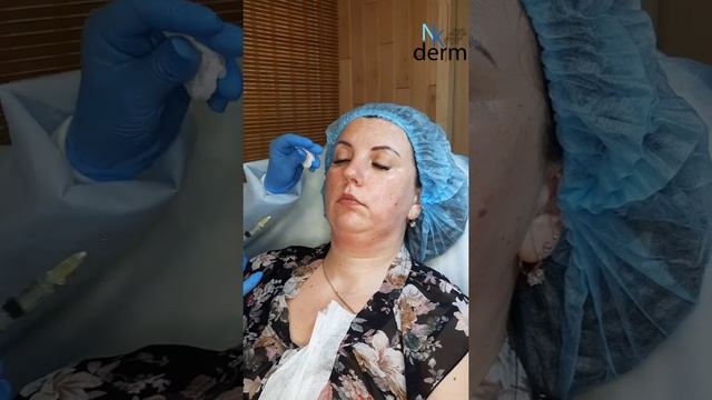 Липолитики в нижнюю треть лица: прямой + непрямой.