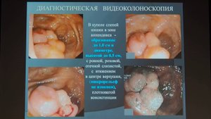 19 Морозова СВ – EMR эпителиального образования купола слепой кишки