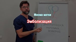 Миома матки. Эмболизация маточных артерий.