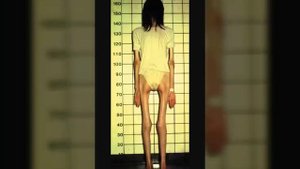 Анорексия подбор фото