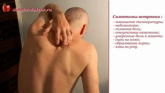 Симптомы появления ветрянки