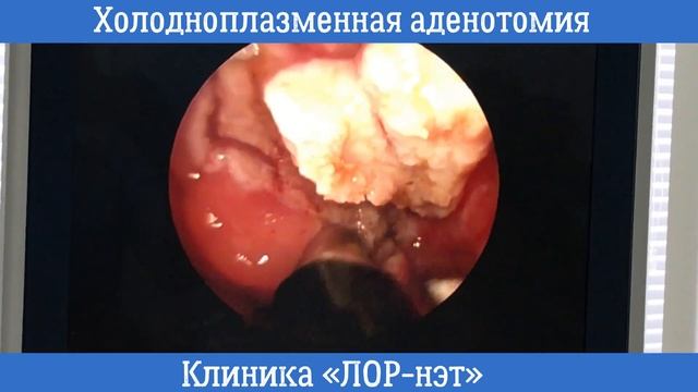Удаление и лечение аденоидов у детей, лазерная и холодноплазменная аденотомия в "Лор-нэт"