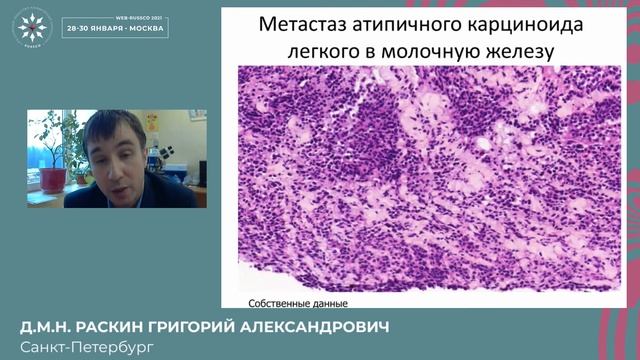 Метастазы в молочную железу: трудности диагностики смотреть онлайн