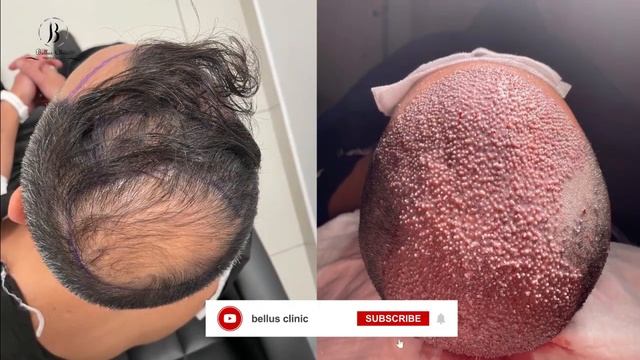 Hair transplant result review from Joseph / hair transplant before and after смотреть онлайн