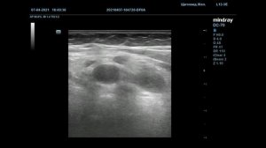 Окклюзивный тромбоз ВЯВ