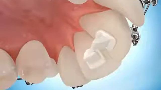 Брекеты Damon Даймон принцип лечения смотреть онлайн